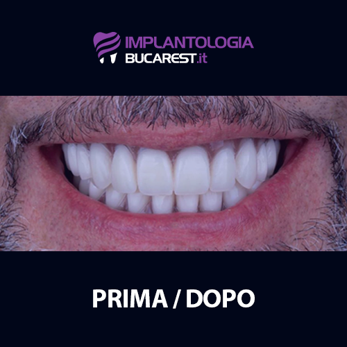 01 dopo impianti dentali impianto dentale dentista romania bucarest