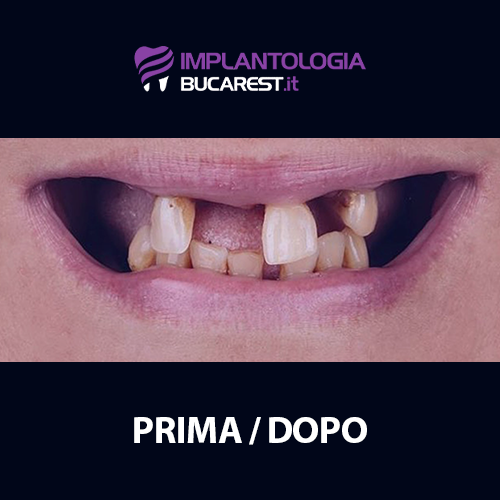 02 prima impianti dentali impianto dentale dentista romania bucarest