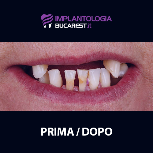 03 prima impianti dentali impianto dentale dentista romania bucarest