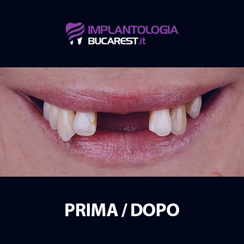 04 prima impianti dentali impianto dentale dentista romania bucarest