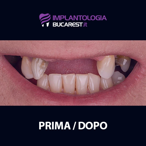 05 prima impianti dentali impianto dentale dentista romania bucarest